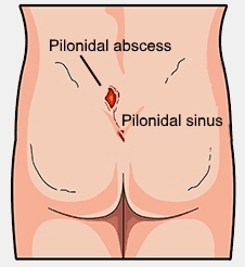 Pilonidal Sinus