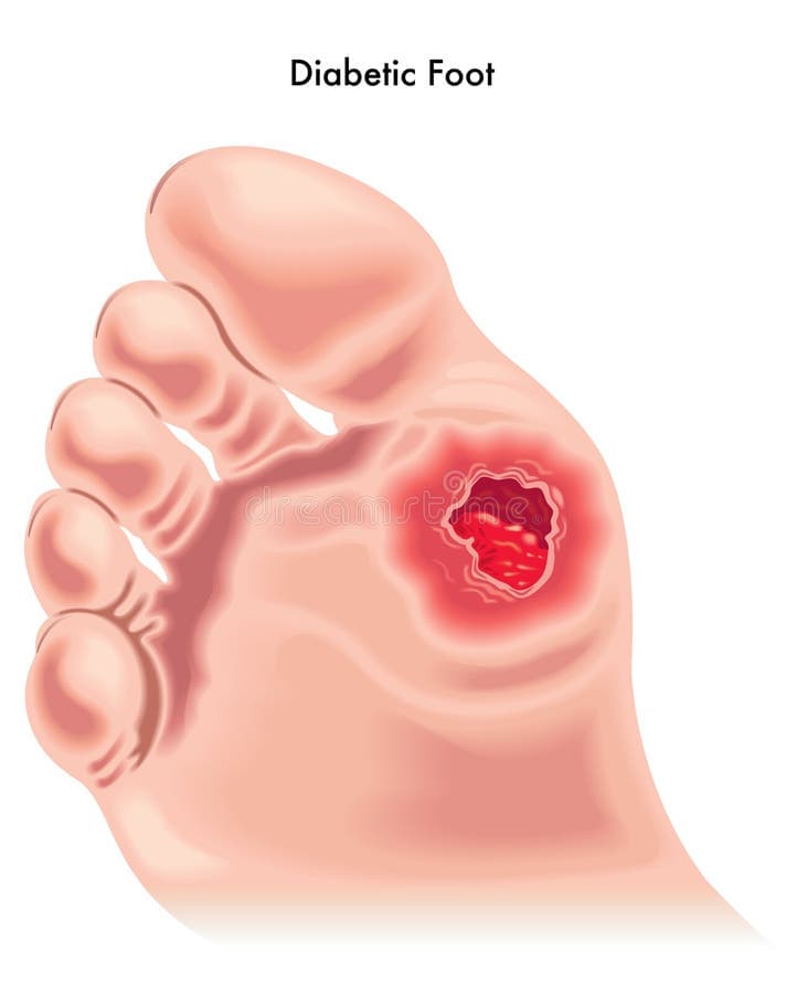 Diabetic Foot Ulcer